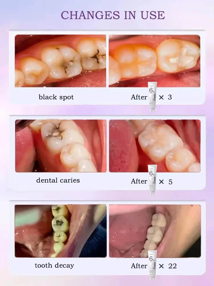 Anti Caries Repairing Cavities Tooth Decay Repair teeth health product