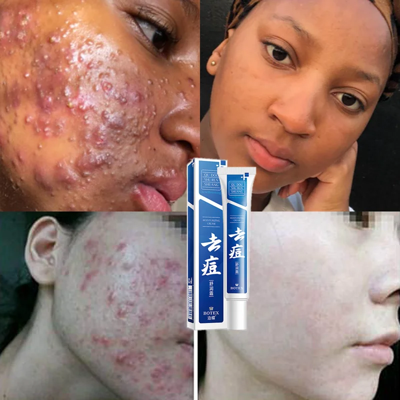 Crema viso per la rimozione dell'acne a base di erbe segni di cicatrice  Spot efficaci Gel per il trattamento dei punti neri restringere i pori  sbiancare i prodotti coreani per la cura