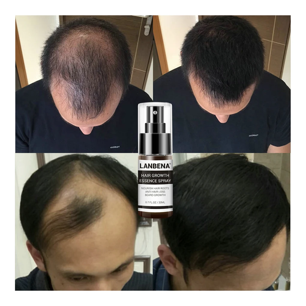 Hair Growth Essence Spray Hair Fragile Spliting Care Essential Oil Liquid 20ml LANBENA for hair growth serum,hair growth spray