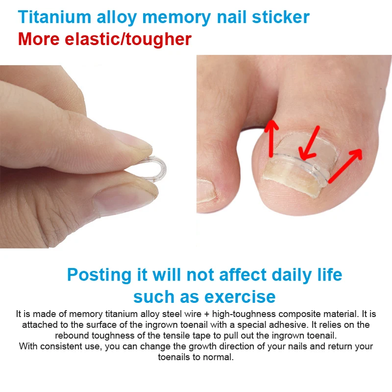 25/30Pcs 13-19mm Nail Correction Stickers Ingrown Toenail Corrector Patches Paronychia Treatment Recover Care Pedicure Tools