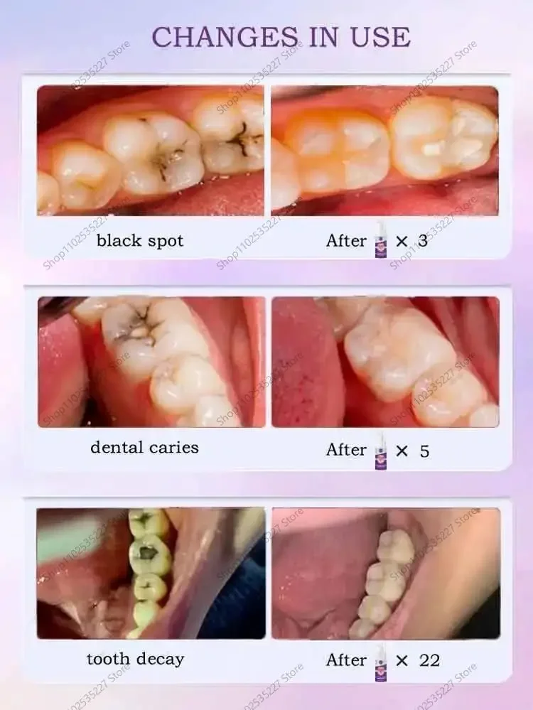 Tooth decay Repair Repairing