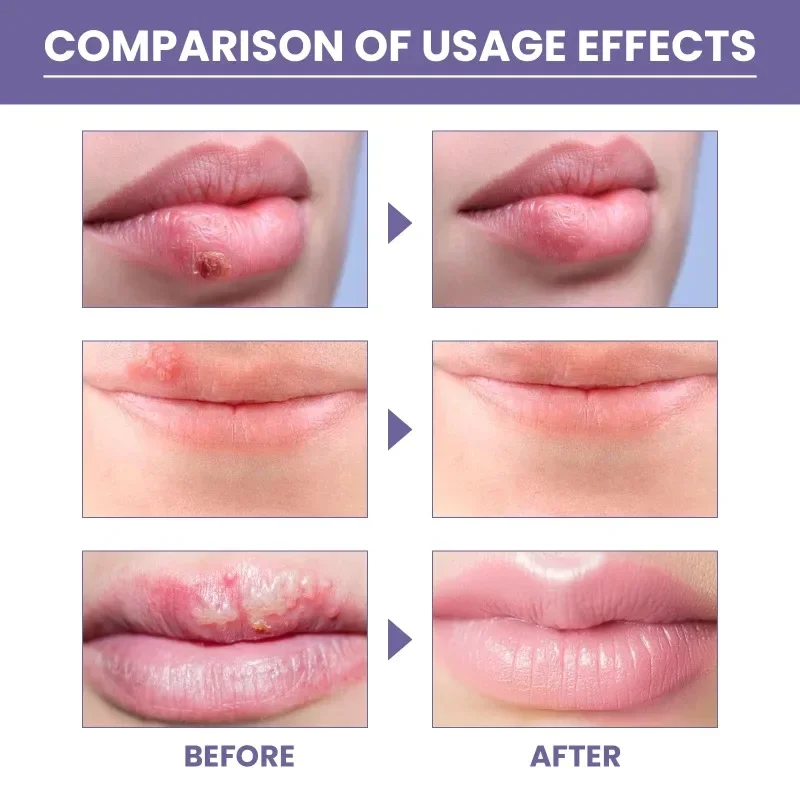 Cold Sores Patch Antibacterial Herpes Paste Repair Lip Skin Barrier Dry Cracked Moisturize Lips Care Treatment Cheilitis Sticker