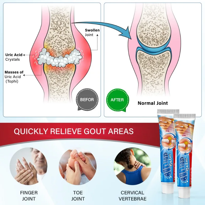 Gout Cream High Uric Bone Damage Relieve Lumbar Spine Stiffness Swelling and Pain Lumbar Disc Herniation Bone Medical Care