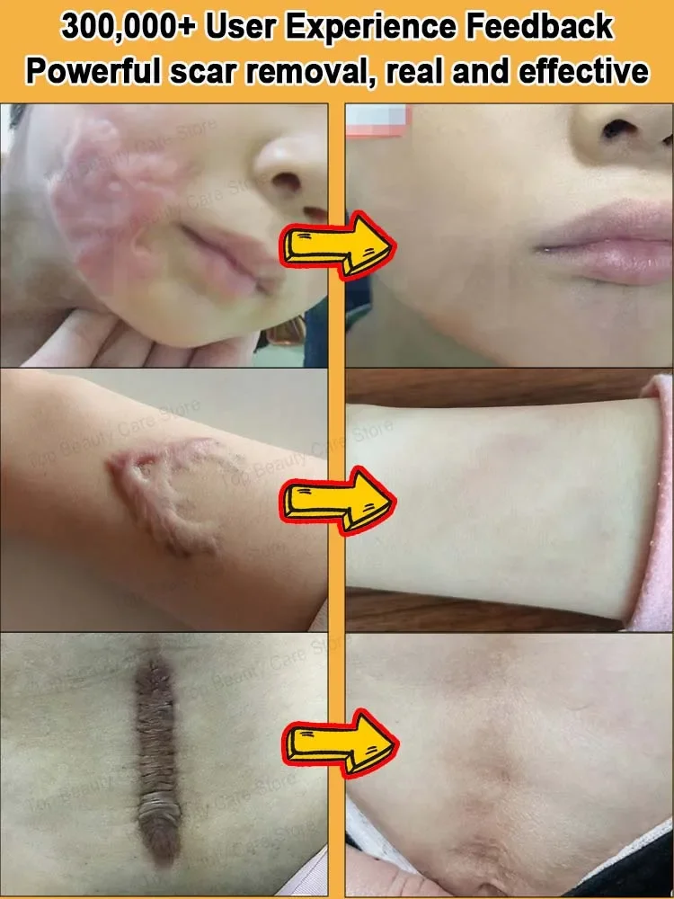 laser scar Suitable for all scar types