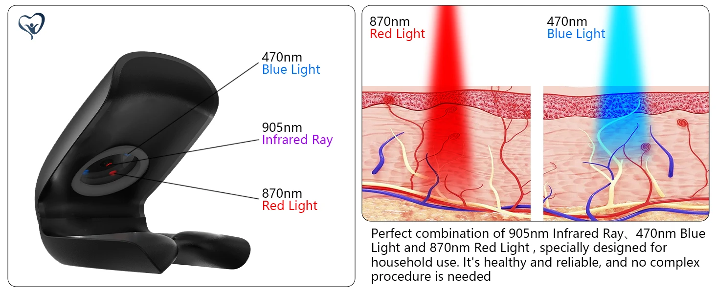 Professionelles Lasergerät Zur Nagelpilzbehandlung Mit Lichttherapie_voghion.com