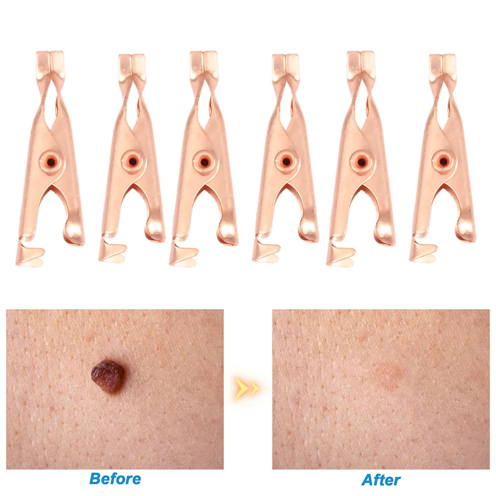 Painless Skin Tag Mole Wart Spot Removal Clips Body Warts Treatment Safe Foot Corn Removal Skin Care Clips Home Use
