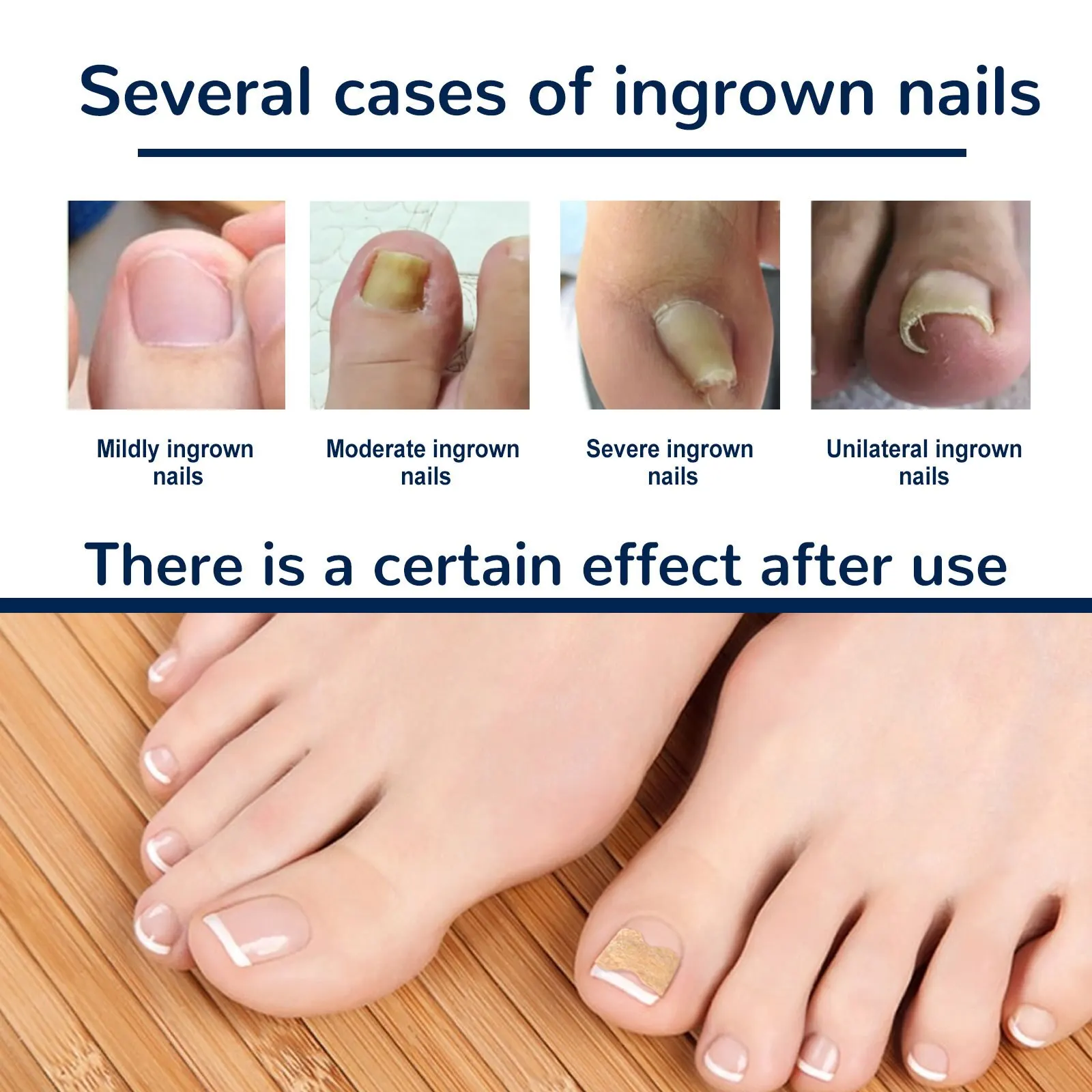 Ingrown Toenail Corrector Sticker 100Pcs Foot Care Pedicure Foot Orthodontic Toe Thumb Nail Care Patches,ingrown toenail correction tool,manicure pedicure tool set,foot care tool,foot pedicure tool,foot care patches,toe corrector,nail problem solving