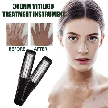 UVB 308 nm ultraviolet lamp for the treatment of vitiligo 308 excimer vitiligo phototherapy device for home use narrow spectrum