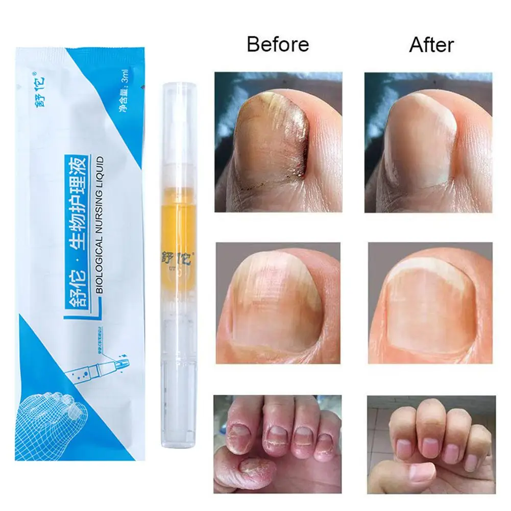 Nail fungus remover 3ml nail treatment solution reusable
