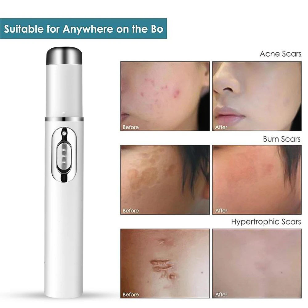 Portable Blue Light Reshaping Laser Pen Varicose Vein Treatment Scar Removal Tool Freckle Acne Treatment Beauty Tool electrotherapy skin care tool blue light therapy pen laser plasma pen remover laser pen therapy