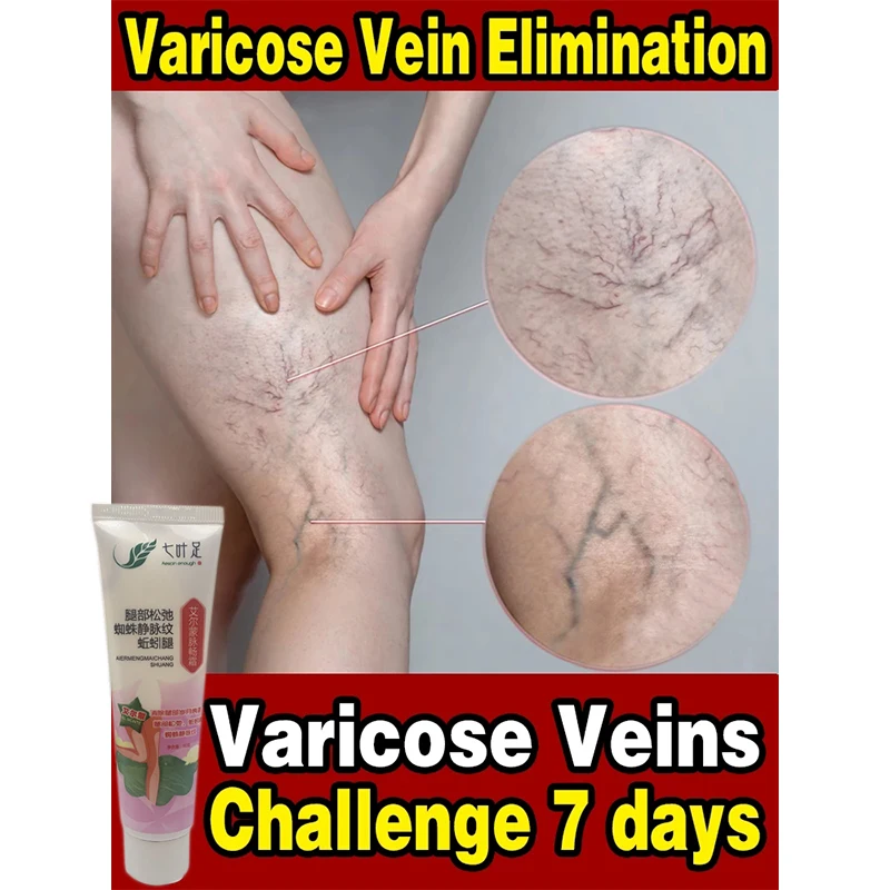 

Effective Varicose Vein Treatment Cream Removal Varizes Spider Legs Vasculitis Phlebitis Sooth Relief Pain Herbal Care Ointment