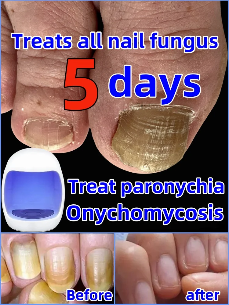 Fungal Nail Laser Device Repair Fast Nails Fungus Onychomycosis
