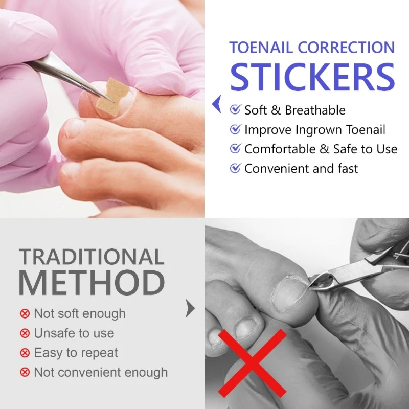 Toenail corrector patch 100pcs paronychia correction ingrown tools pedicure removal stickers