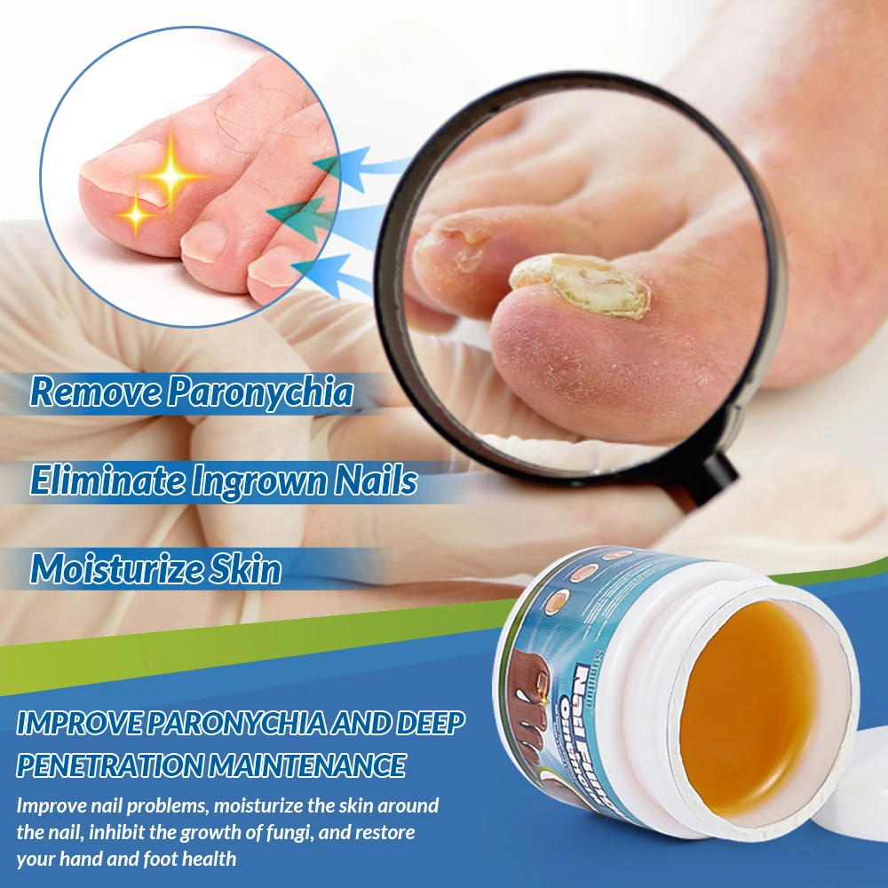 20G/box Sumifun Nail Fungus Treatment Cream Herbal Extract Paronychia Onychomycosis Repair Ointment Anti Infection Foot Care antibacterial anti fungal cream,nail fungus treatment patches
