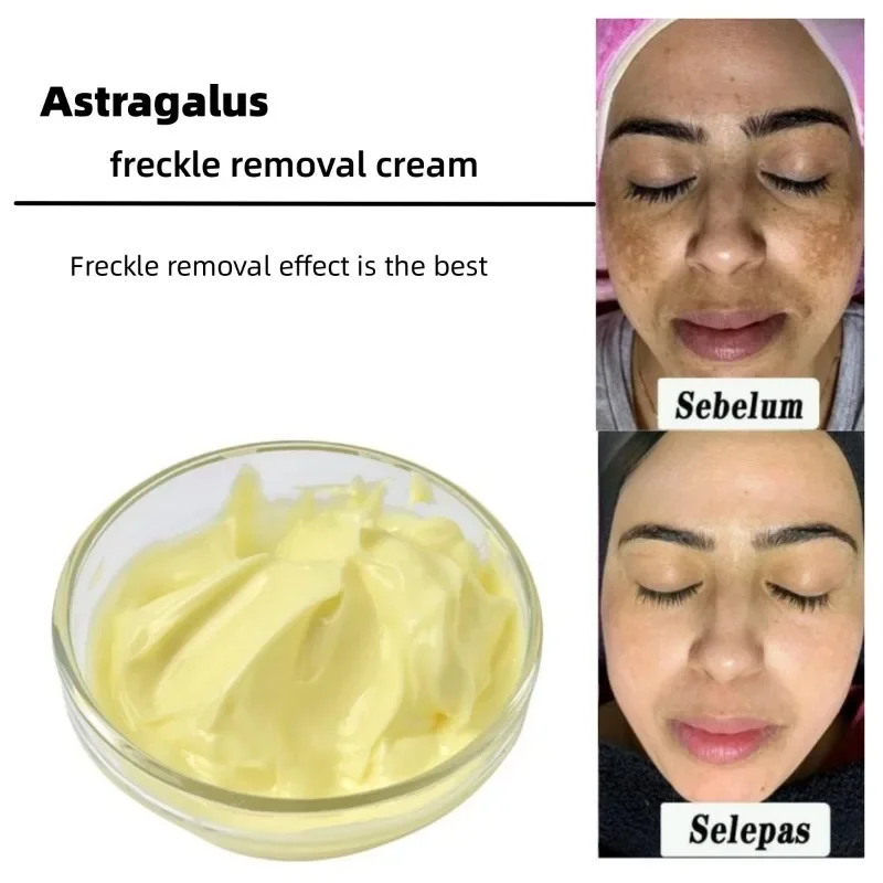 Astragalus Freckle Removal Cream , Herbal Quick Spot Remover, Facial Treatment