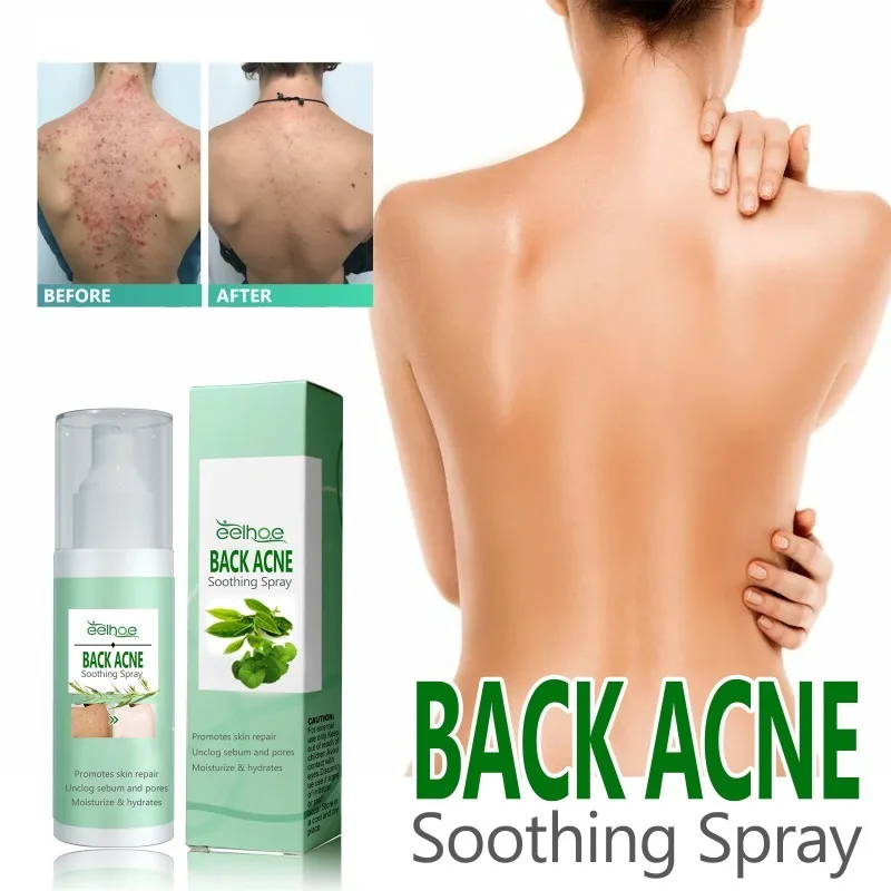 Whitening Cream Back Acne Repair Spray Acne Removal Essence Oil Oil Butt Shoulder Care Cream Control Back Whitening Moisturize Removal Spray