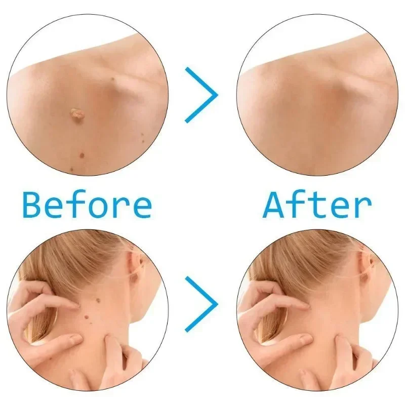 Skin Care Rubber Bands Skin Tag Remover Skin Tag Removal Kit Face Care Mole Wart Tool Skincare Green Beauty & Health 3