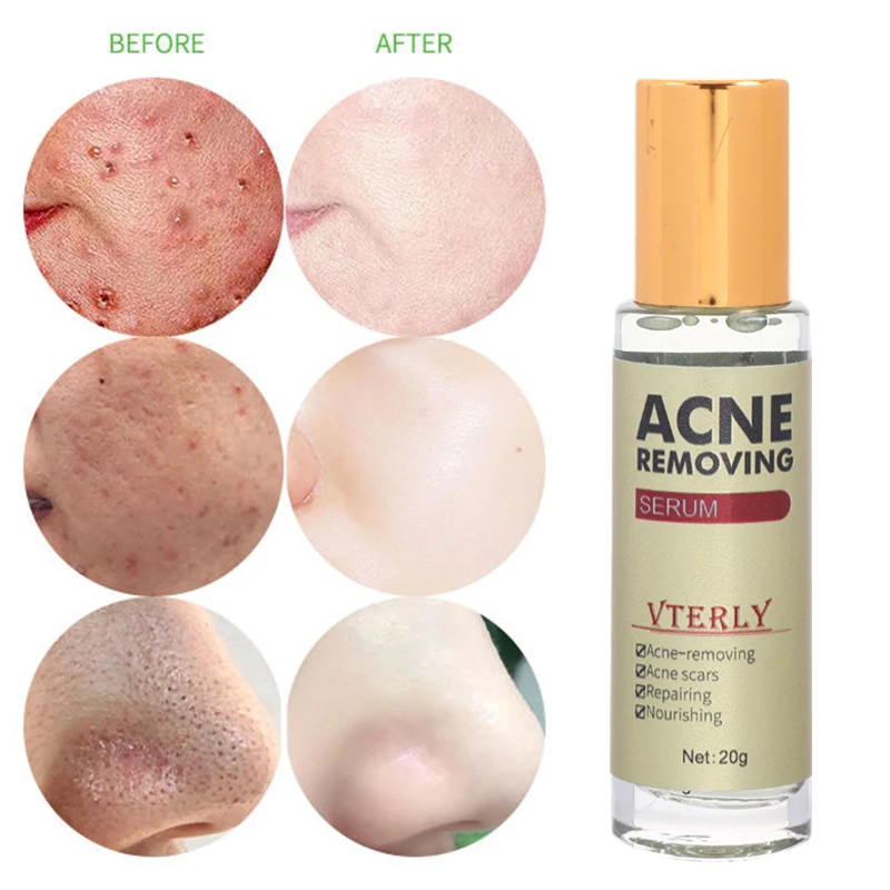 2 Days Effective Organic Facial Skin Care Pimple Repair Fade Marks Treatment Remove Acne Removal Serum