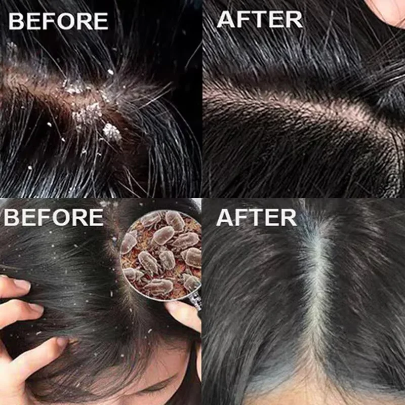 Scalp Treatment Fast Anti Exfoliating Scrub Remove Dandruff Anti Itching Seborrheic Scalp Oil Control Repair Scalp Beauty Health Care