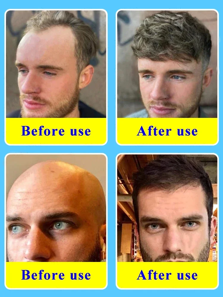 women/men Rapid Hair Growth Essential Oil Repair Baldness Hair Oil for Fast Growth Beard Growth Oil Hair Treatment