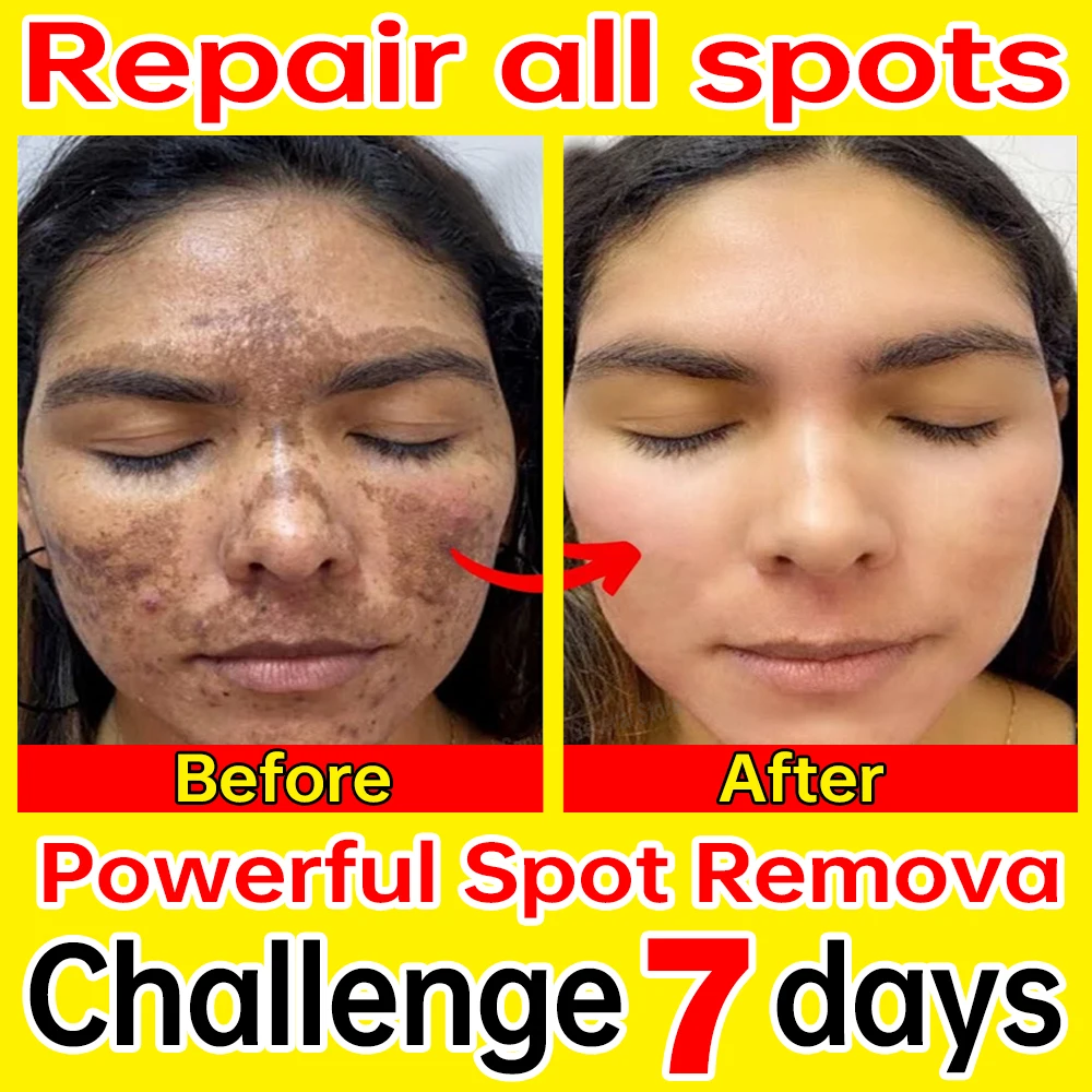 

Freckles Removal Facial Essence Remove Facial Spots Skin Dark Spot Remove Melasma Age Spots Sunspots Whitening Freckle Removing