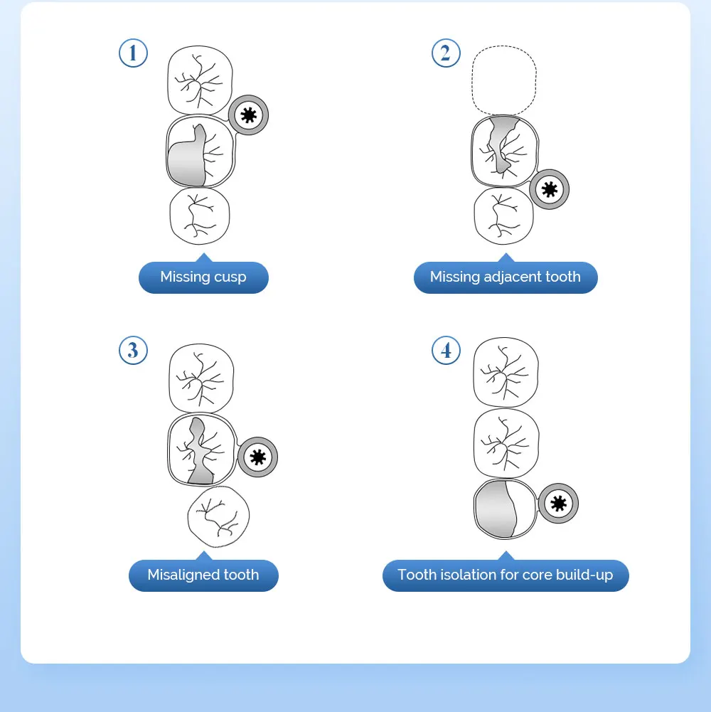 50 Stück JOY DENTAL Dental-Matrixbänder, Stahlmatrix, doppelseitig konturiert, anatomisch geformte Matrixbänder für die Zahnmedizin – Detail 3