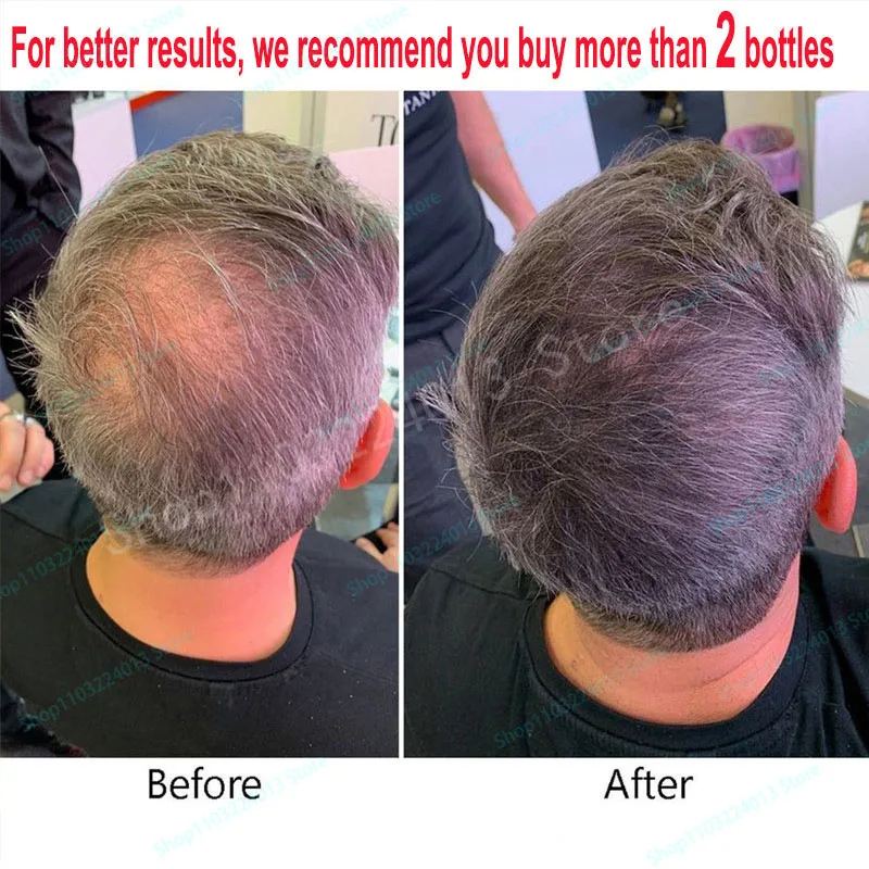 Description Picture 2 of itemNatural Ginger Hair Growth Spray Hair Roots Fast Grow Anti Hair Loss Serum Liquid Scalp Damaged Treatment Repair Beauty Health