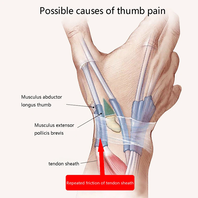 Verstauchte Handgelenkstütze mit Daumenstabilisator, Unisex, Sehnenentzündung, Auslöser, Finger-Daumenschiene, Arthritis-Schmerzen, Daumenstütze, Handauslöser – Detail 4