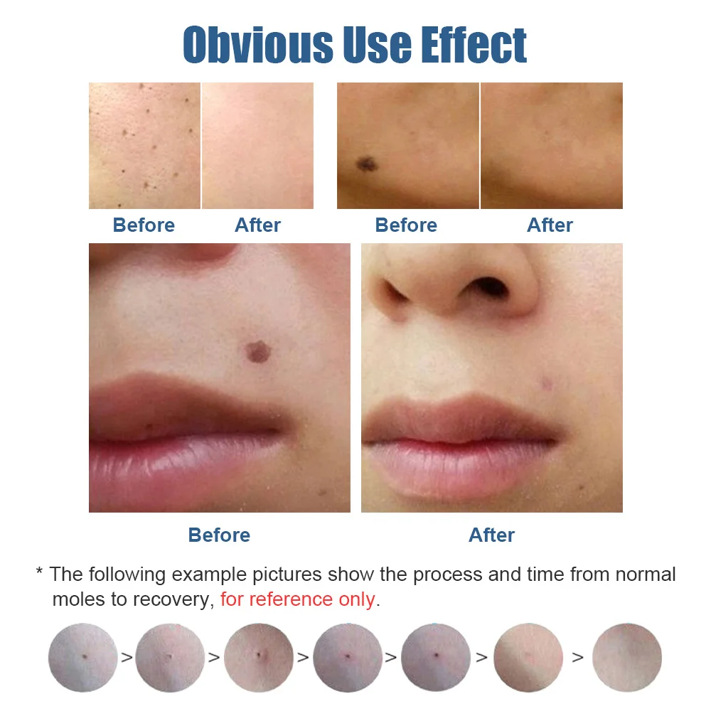 Skin Tag Remover Laser Plasma Pen Eliminator Wart Cauterizer Laser Pen Papilloma Removal Plasma Jet Acne Tattoo Berrugas Mole Polka Dot Remover Kite Skin Cleaning