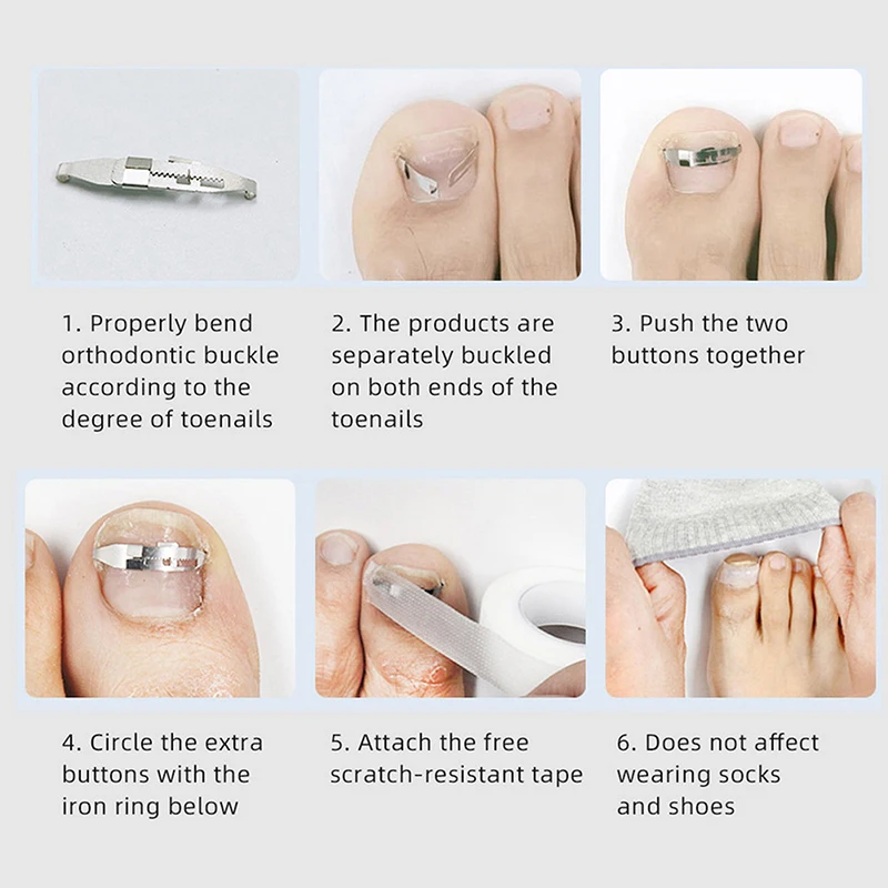 Ingrown Toenail Corrector Tools Pedicure Recover Embed Toe Nail Treatment Professional Ingrown Toenail Correction Foot Care Tool 3