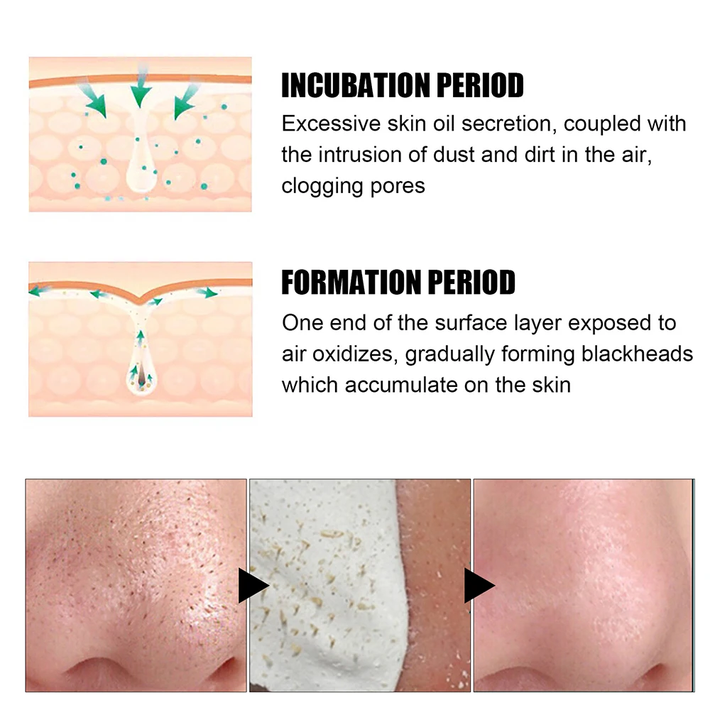 New Blackhead Remover Nose Mask Pore Strip With 60pcs Paper Deep Face Cleaning Nasal Strips Peeling Acne Treatment Skin Care 3