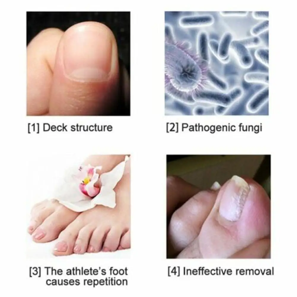 Nail fungus remover 3ml nail treatment solution reusable