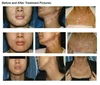 308nm Handheld uvb Light Therapy Portable Effective To Treat vitiligo Psoriasis Eczema Uvb Lamps Uv Phototherapy Instrinstrument 4