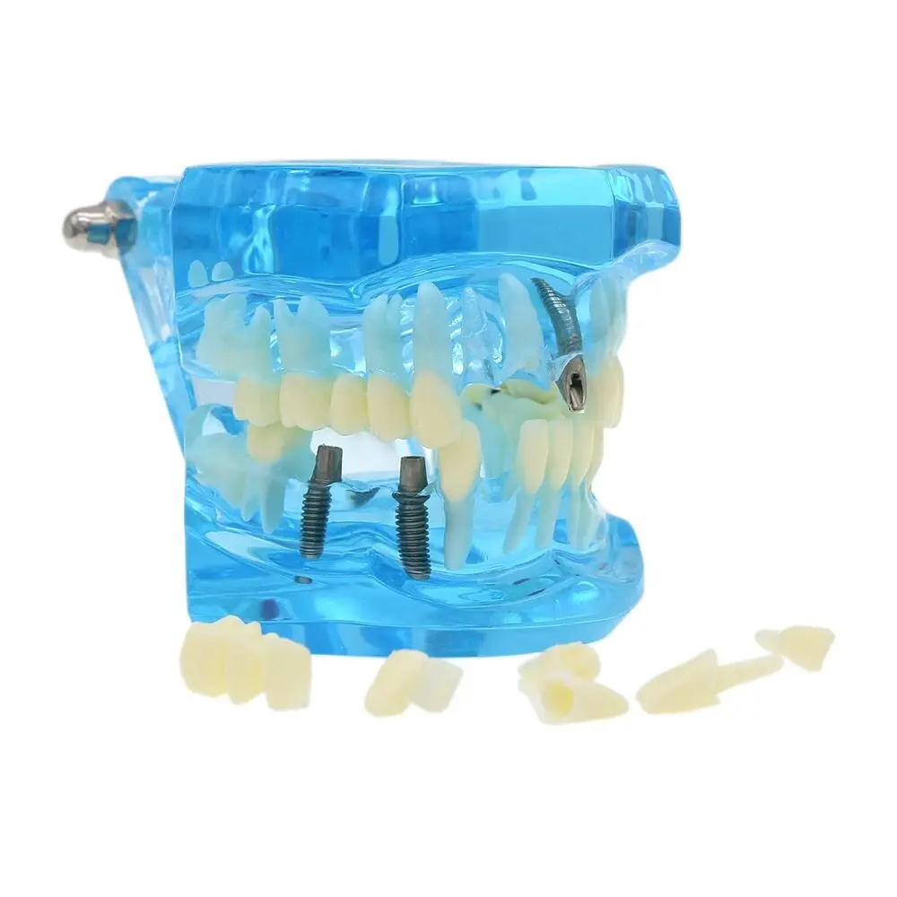 

Dental Implant Teeth Model Bridge Restoration Pathology Teach Study Demo M2001 Blue for Schools and Colleges