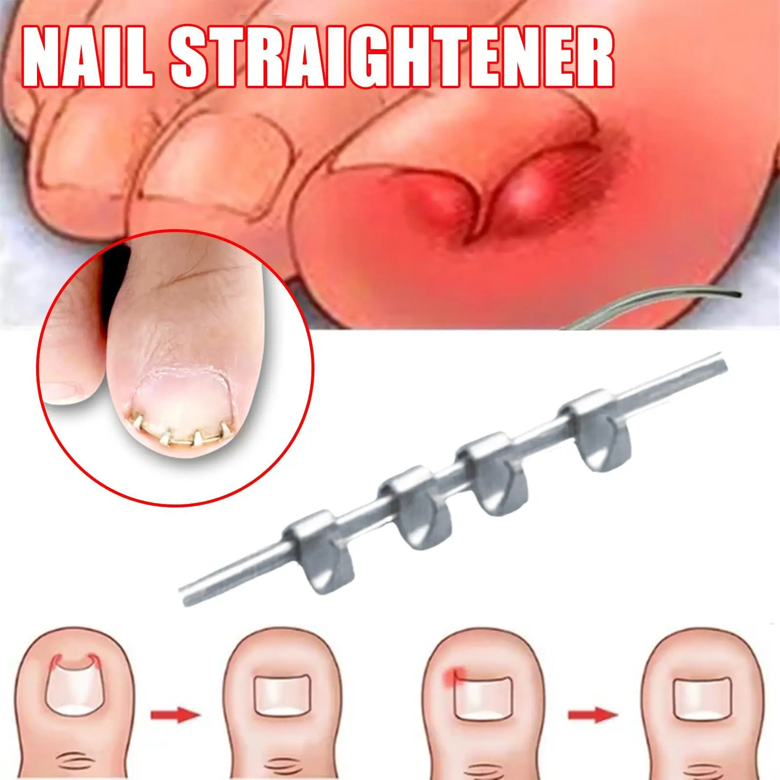 

1PCS Professional Ingrown Toe Nail Correction Wire Fixer Treatment Tool Pedicure Paronychia Recover Toenails Corrector Reusable