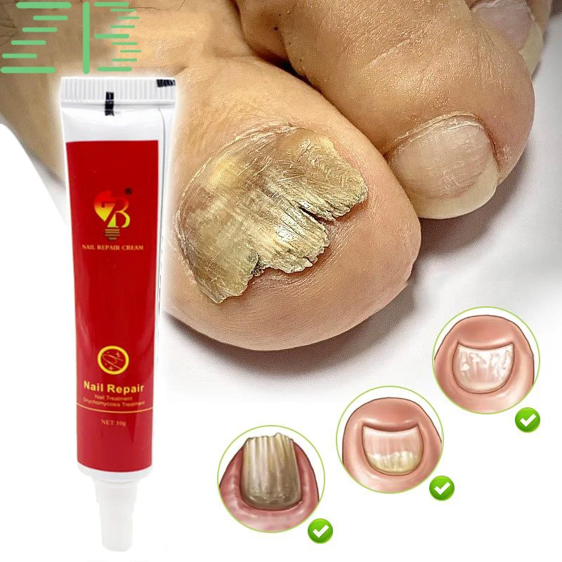 

10g Chinese Herbal Toe Nail Fungus Treatment Cream Onychomycosis Paronychia Antibacterial Anti Fungal Infection Repair Ointment
