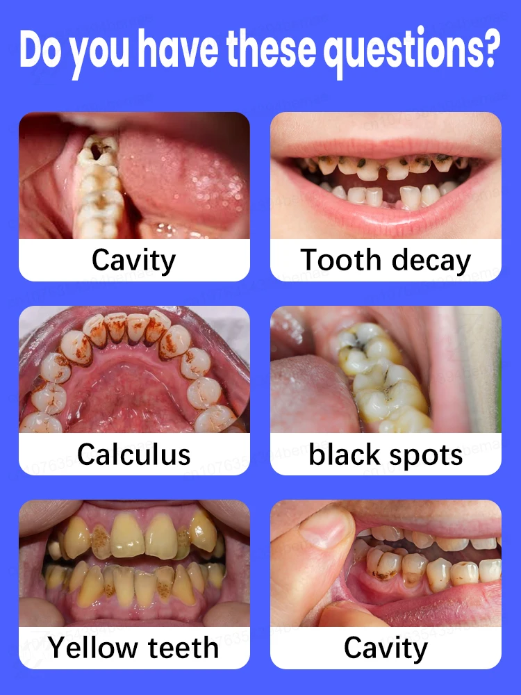 Probiotic Toothpaste Solves Tooth Gum Pain Prevents Dental Problems Whitens Teeth