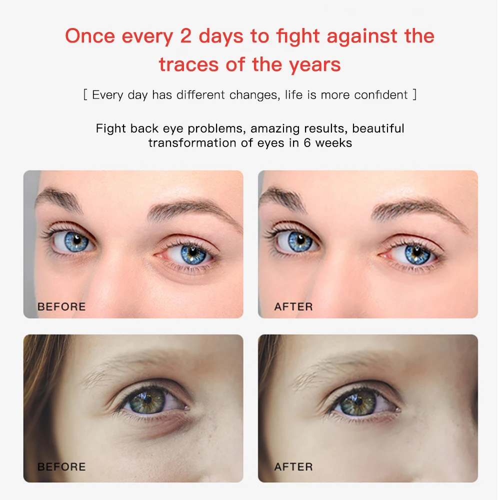 Eye and Face Lifting EMS Beauty Device 2 in 1 New RF Wrinkle Removing Eyelid Massager Skin Care Skin Rejuvenation Anti-Ageing 2