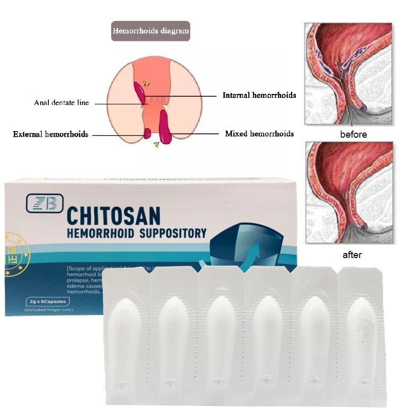 Hemorrhoid Ointment Treatment Internal And External Hemorrhoids And Anal Bleeding Relieve Swelling Pain herbal hemorrhoid treatment