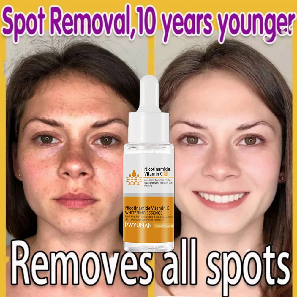 Nicotinamid Whitening Freckles Face Serum Fade Dark Spots Melasma Melanin Removal Firm Brighten Moisturizer Skin Care_voghion.com