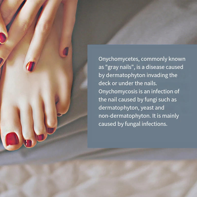 Nail fungus treatment LED laser device for cleaning onychomycosis USB charge 905nm infrared light 470nm blue light nail salon nail fungus remover personal health care laser therapy pen