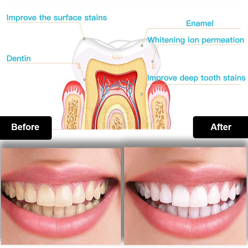 Dental Teeth Whitening Kit Mini 16 LED Cold Light 35% Carbamide Peroxide Gel Tooth Whitener Bleaching Pen Oral Tray Device Set teeth whitening gel teeth whitening kit
