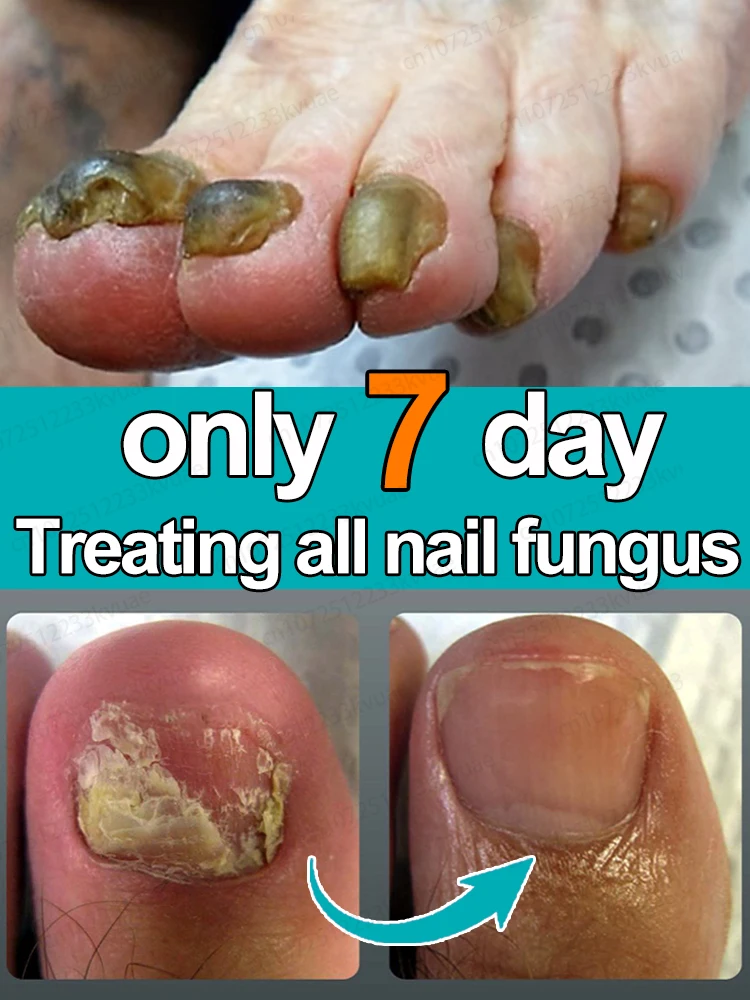Nail fungus treatment essential oil repair onychomycosis in 7 days fungus solution,organic essential oil