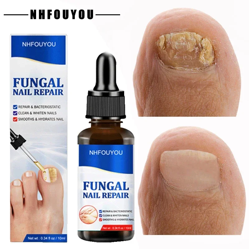 

Nail Fungal Treatment Serum Anti Infection Onychomycosis Paronychia Toe Fungus Hand Foot Removal Repair Gel Care Beauty Health