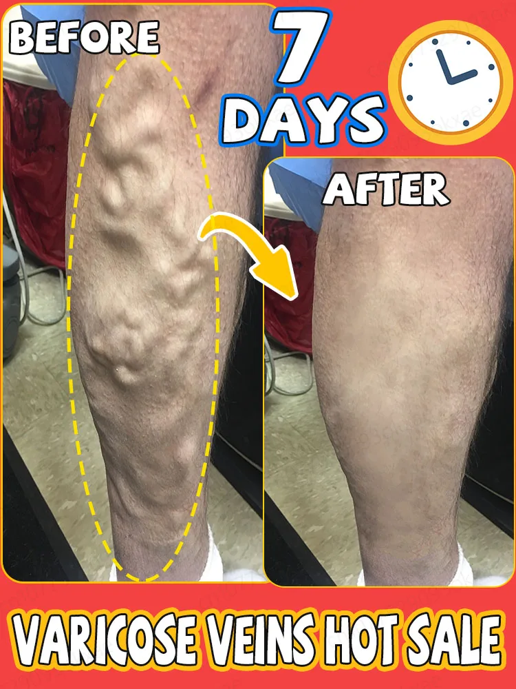 Say goodbye to varicose veins