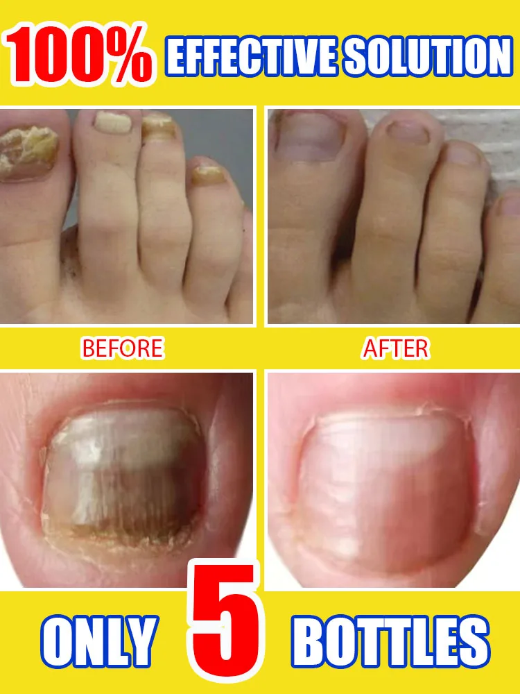 Fungus Solution Organic Essential Oil Toenail Nail Fungus Treatment Repair Fingerail Device Toenail Treatment for Foot Nail Fungus Essential Oil Onychomycosis Care