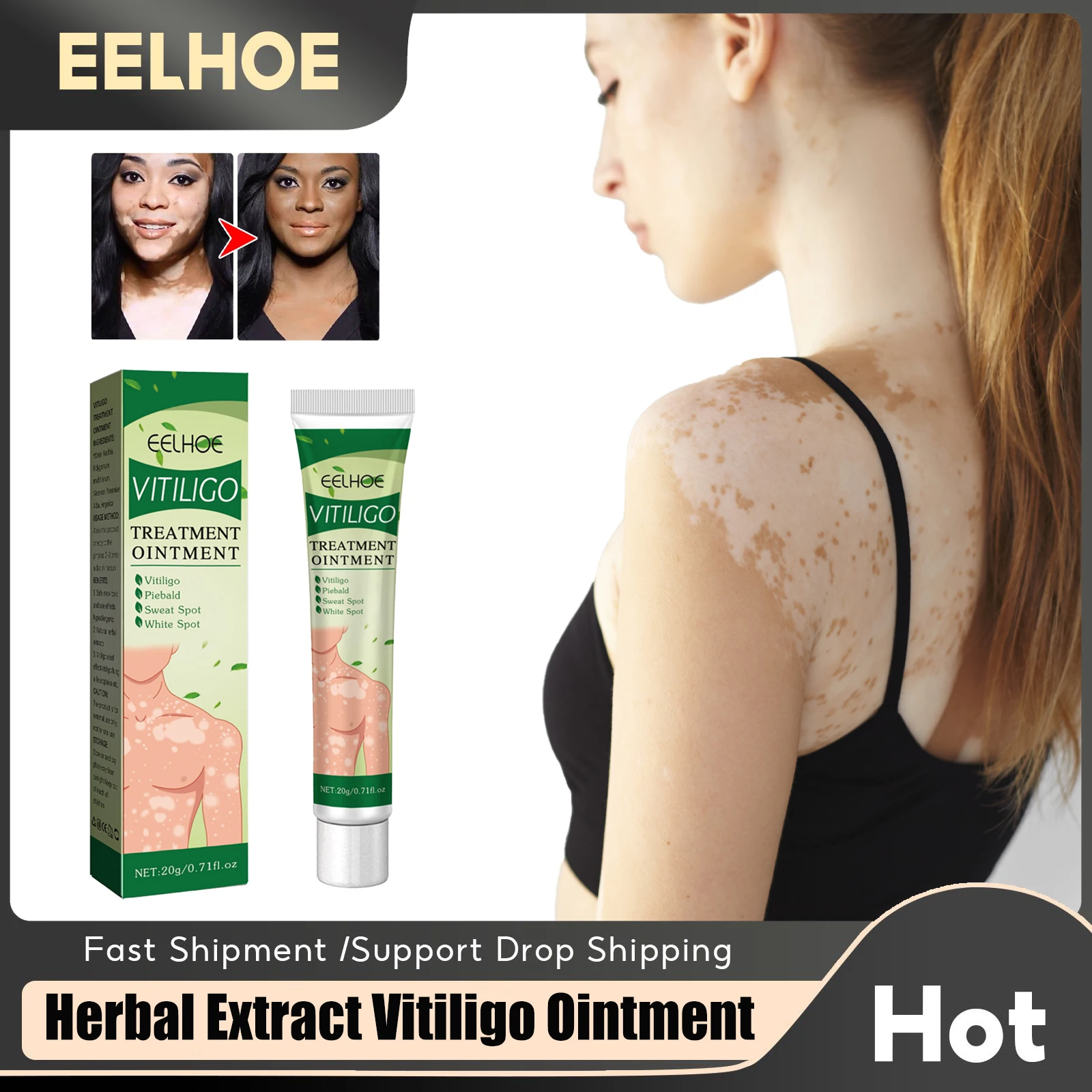 Piebaldism Vs Vitiligo