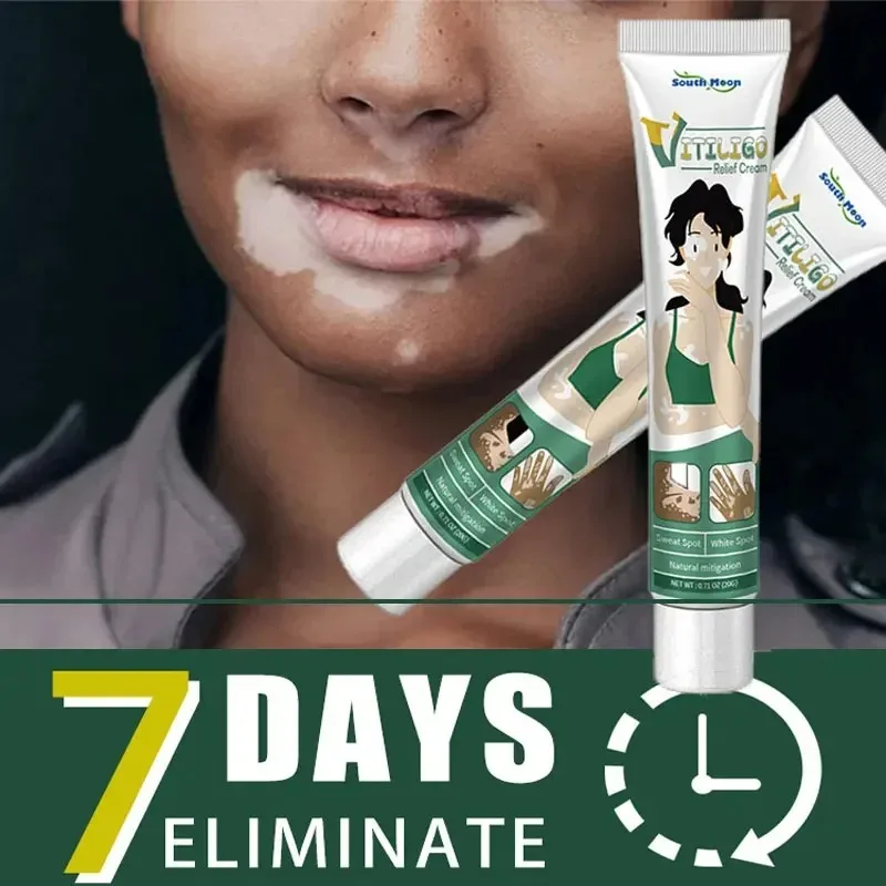 Gallery Detail: Vitiligo Ointment Herbal Extract Remove Ringworm White Spot Removal
