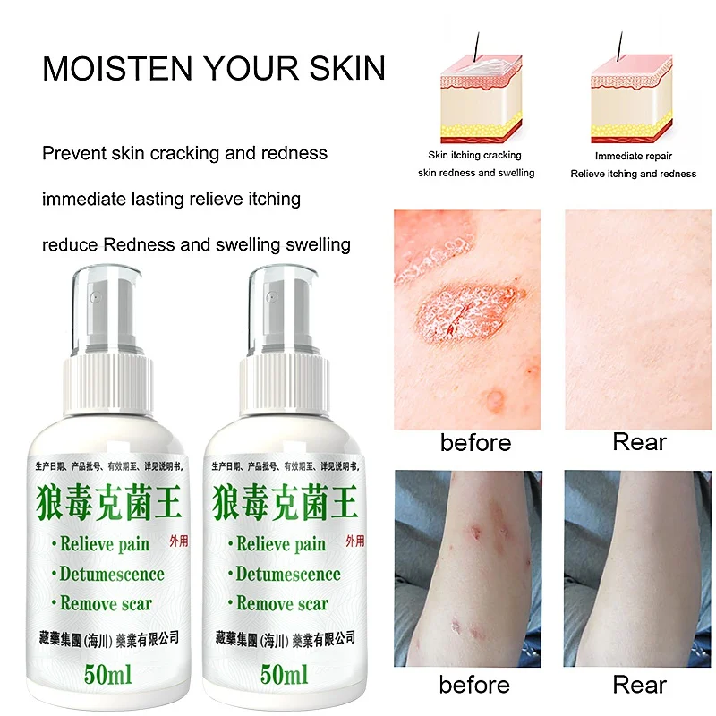 50ml Herbal Eczema Psoriasis Spray Antibacterial Dermatitis Athletes Foot Relieve Itching Irritation Allergies Skin Care