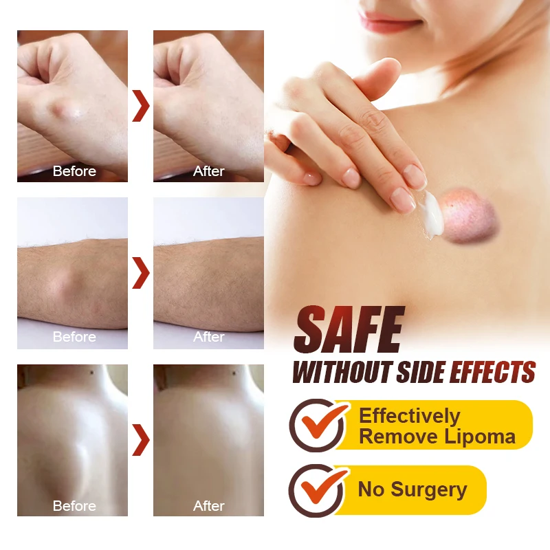 Pain relief cream,skin care ointment 1Pcs Lipoma Removal Cream Relief Pain Skin Swelling Lipolysis Cellulite Fat Lump Nodule Removal Ointment Anti-tumor Plaster G040